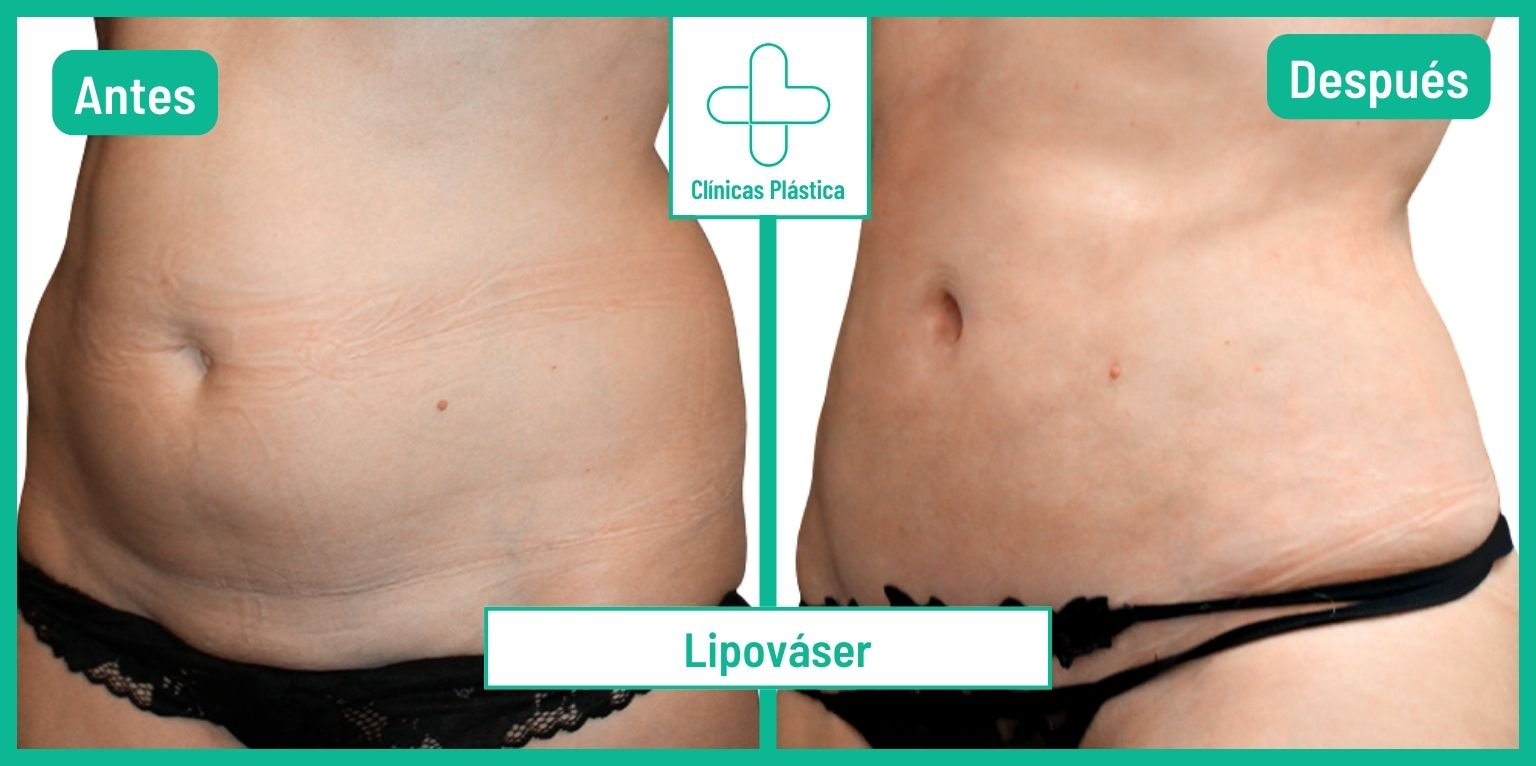 Lipováser antes y después Lipovaser antes y despues